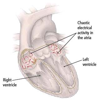 VHFC0015_What_is_atrial_fibrillation_and_what_are_the_risks_image1.jpeg