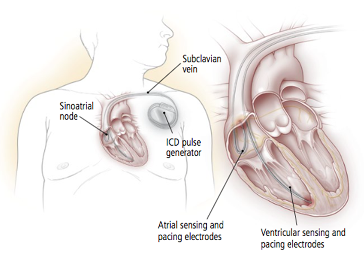 VHFC0070_What_is_an_implantable_cardioverter_defibrillator__ICD__and_how_can_it_help_image1.png