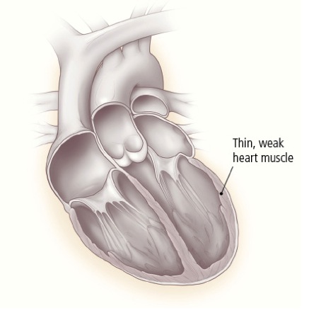 VHFC0198_What_are_the_different_types_heart_failure_image1.jpg