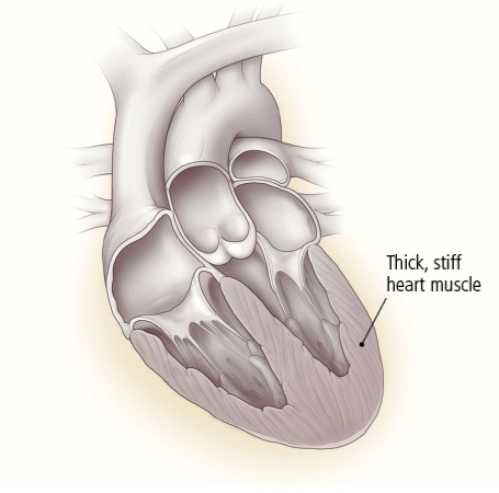 VHFC0198_What_are_the_different_types_heart_failure_image2.jpg